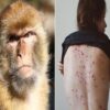 Confirma el subsecretario de Salud, López-Gatell primer caso de la viruela de mono en México