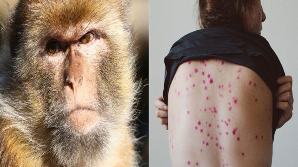 Confirma el subsecretario de Salud, López-Gatell primer caso de la viruela de mono en México